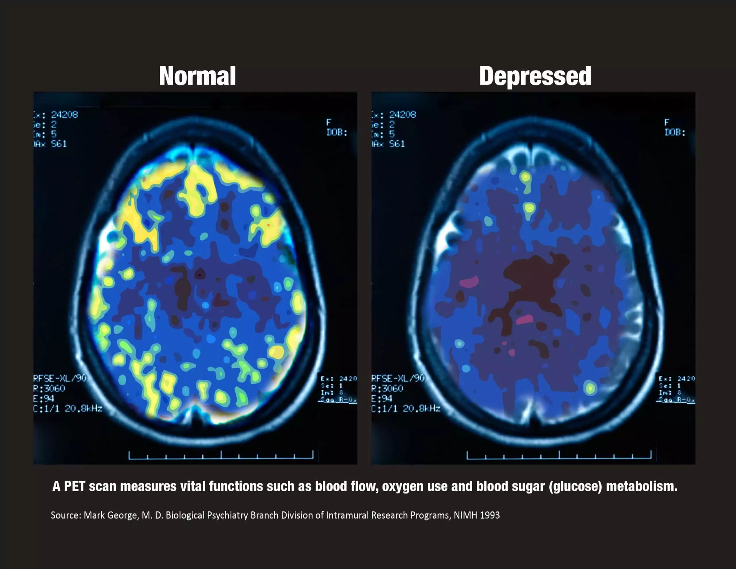 PET Scan with MGeorge ref_blk