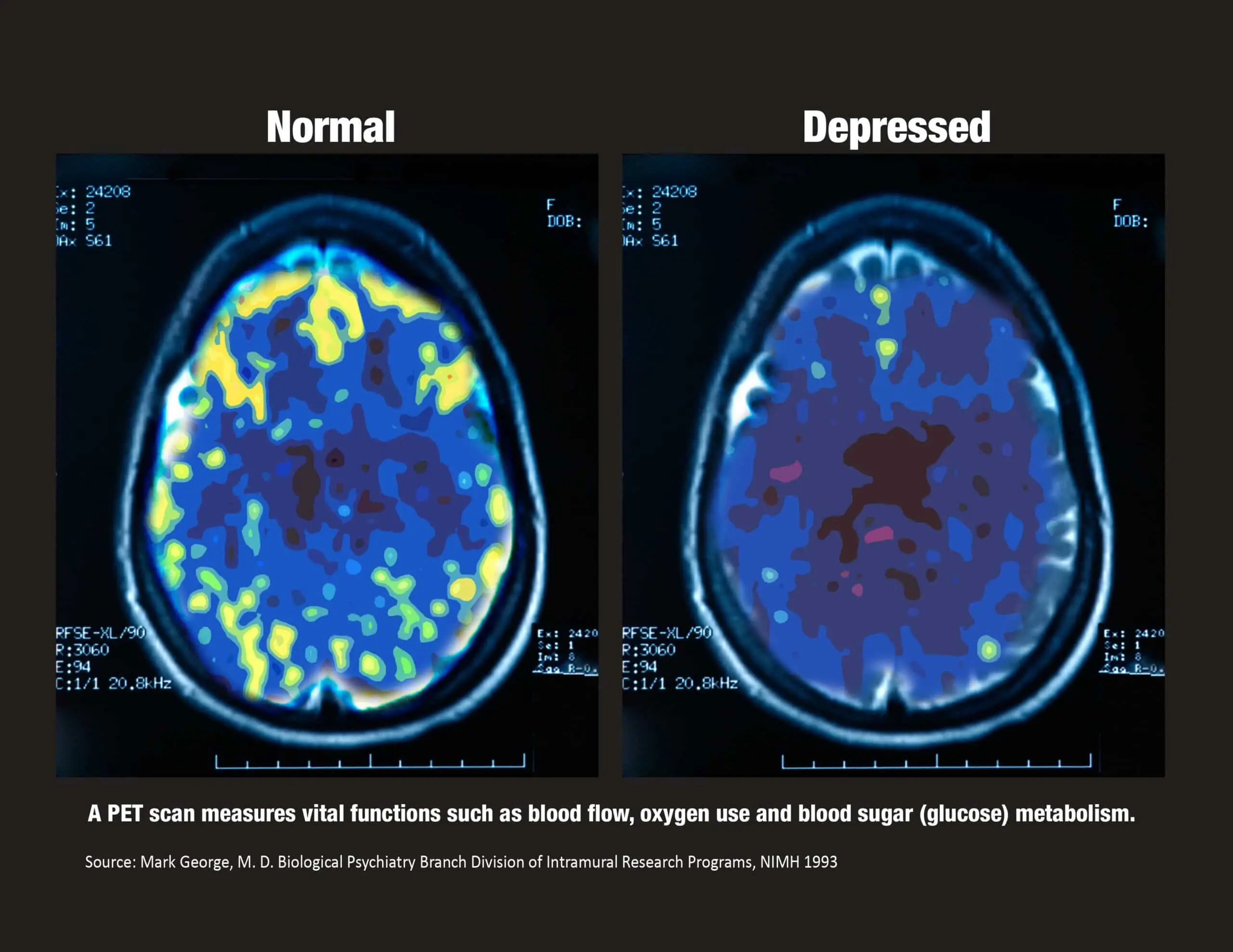 BestMind-depression-scan BestMind depression scan