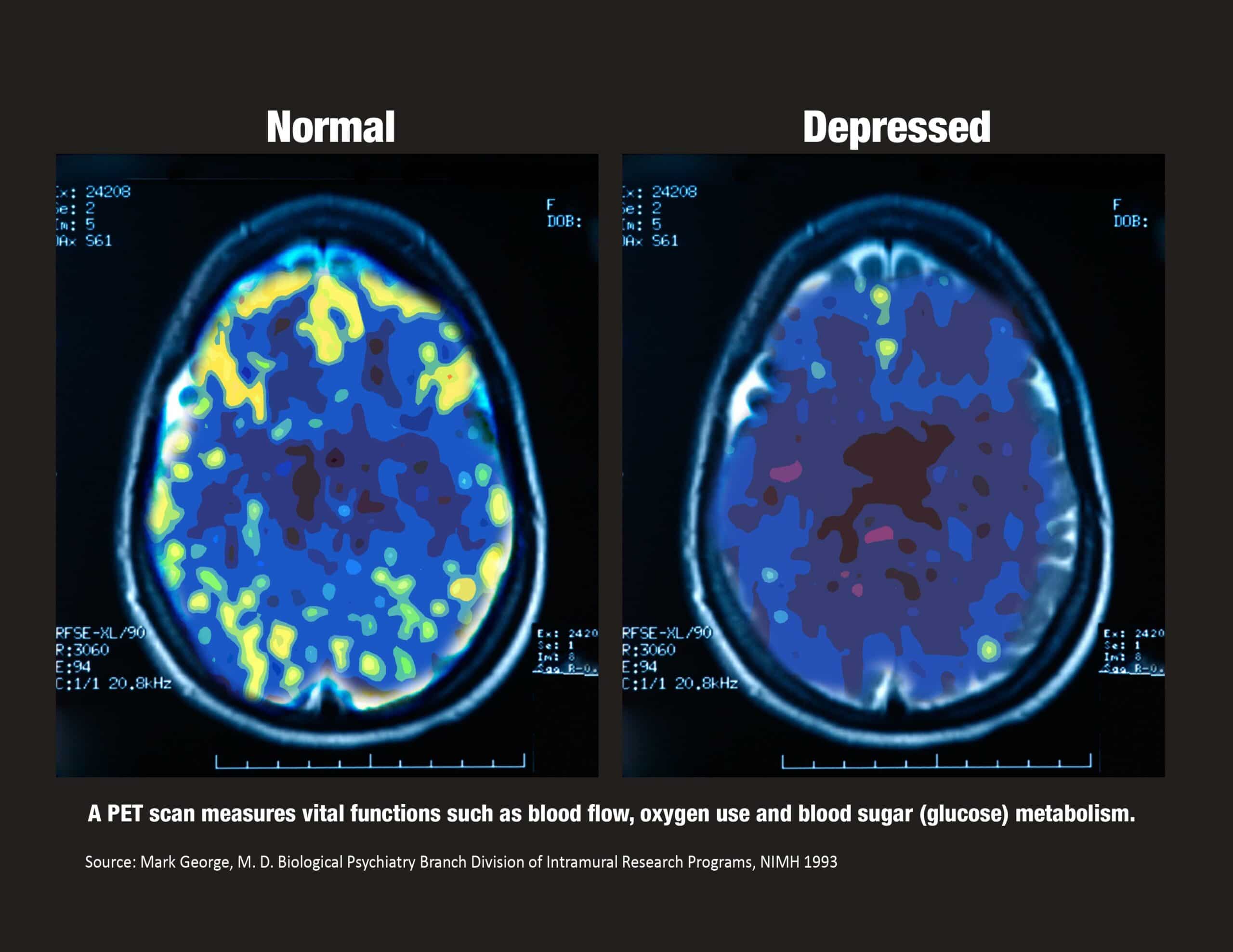 PET Scan with MGeorge ref_blk