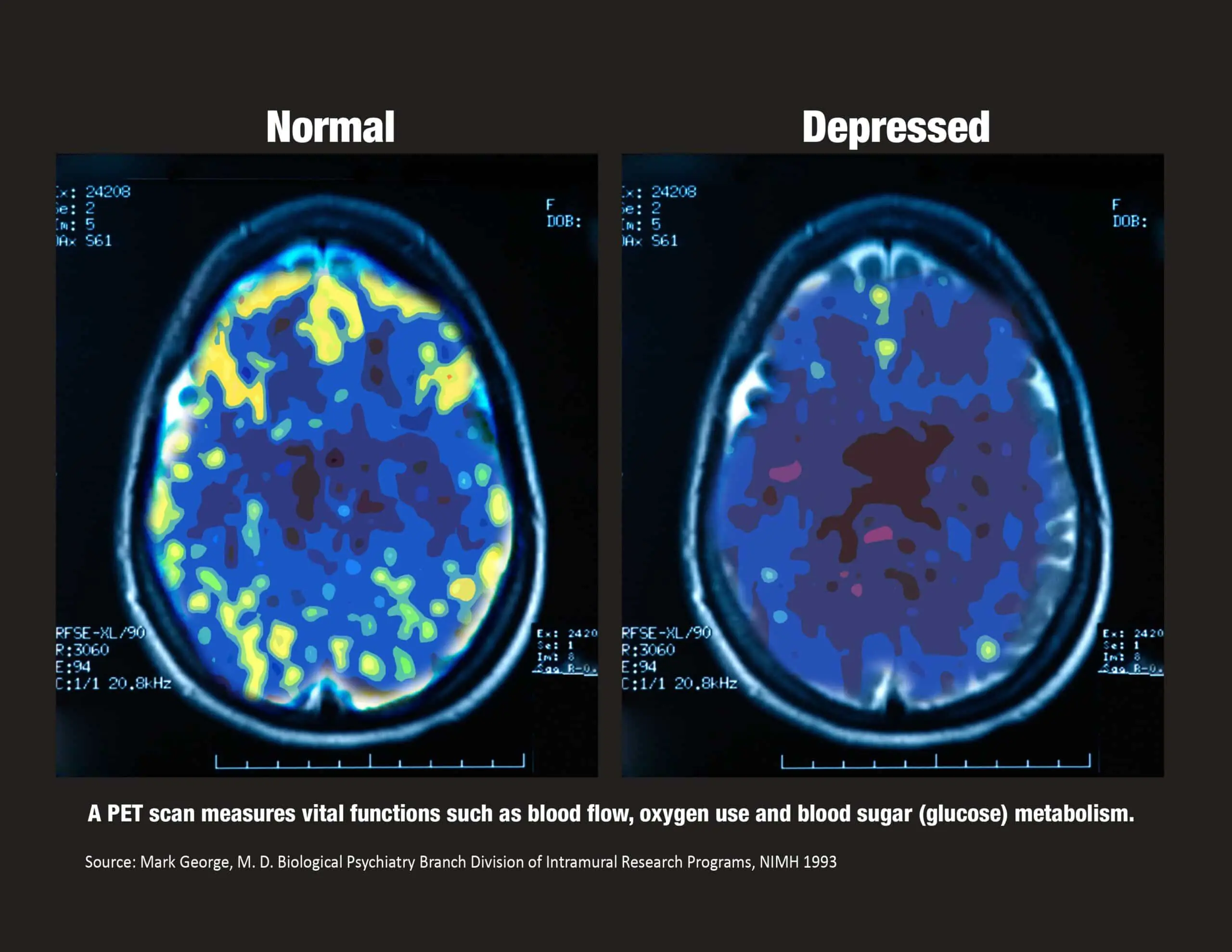 PET Scan with MGeorge ref_blk